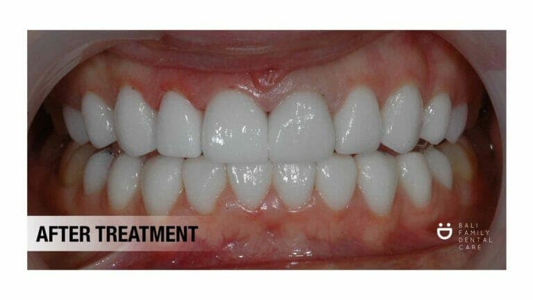 Porcelain Veneers