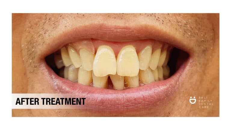 Removable Denture