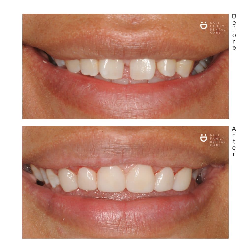 Crowns - Image 2
