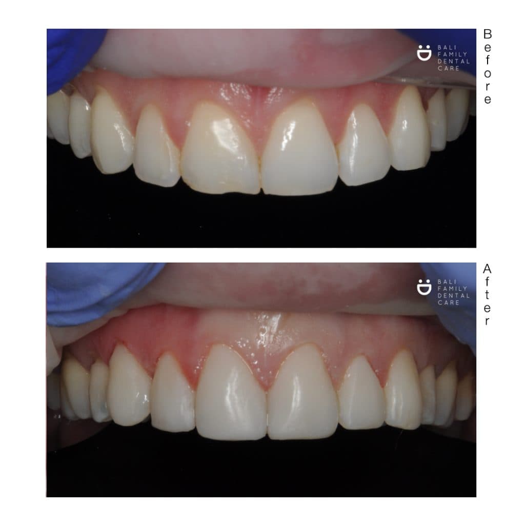 Crowns - Image 1