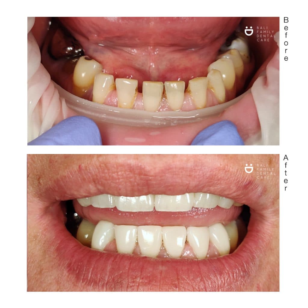 Crowns - Image 3