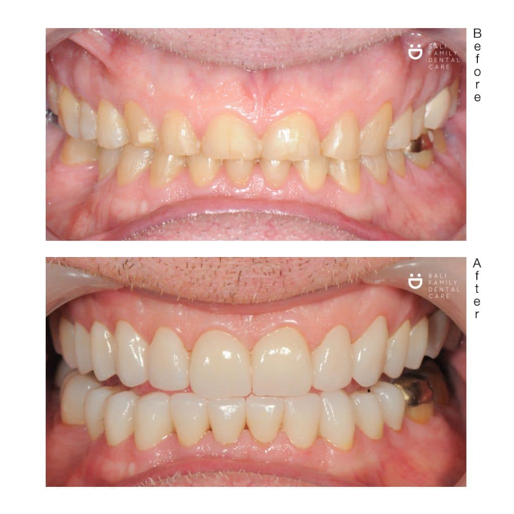 Removable Denture - Image 1