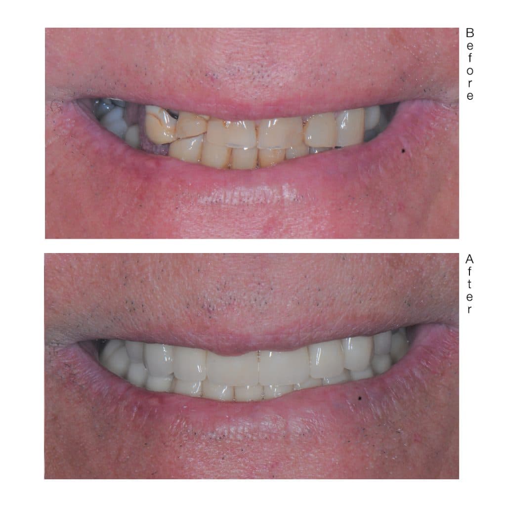 Teeth Whitening - Image 3